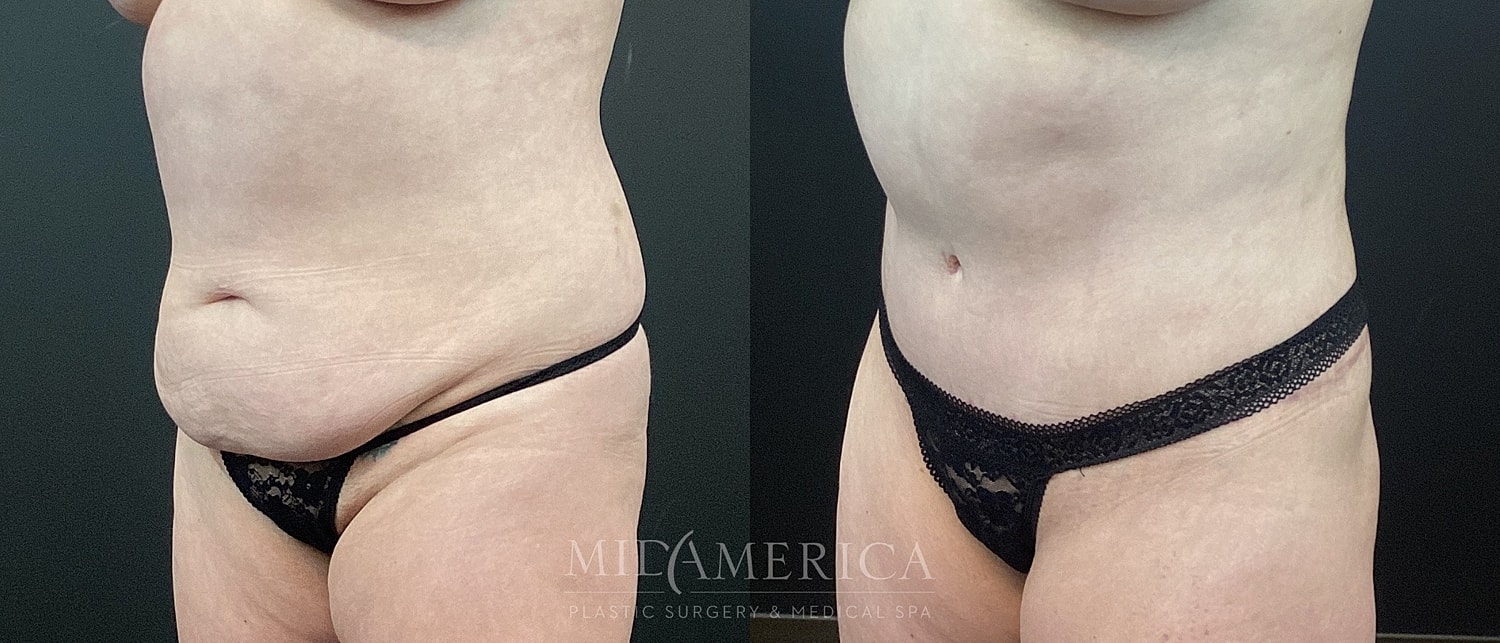 Tummy Tuck Before & After
