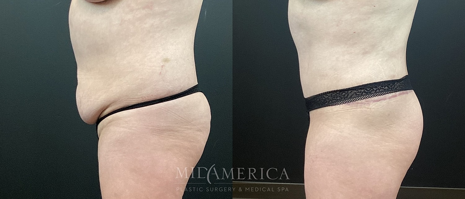 Tummy Tuck Before & After