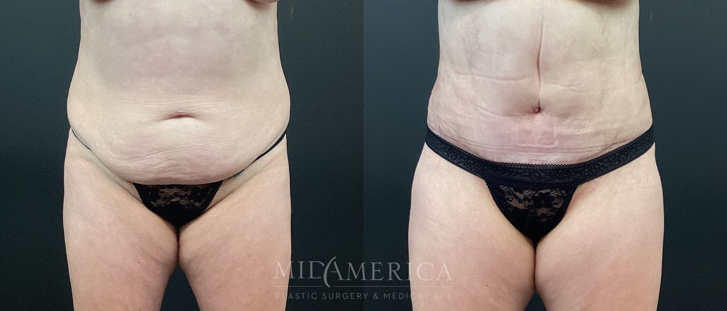 Tummy Tuck Before & After