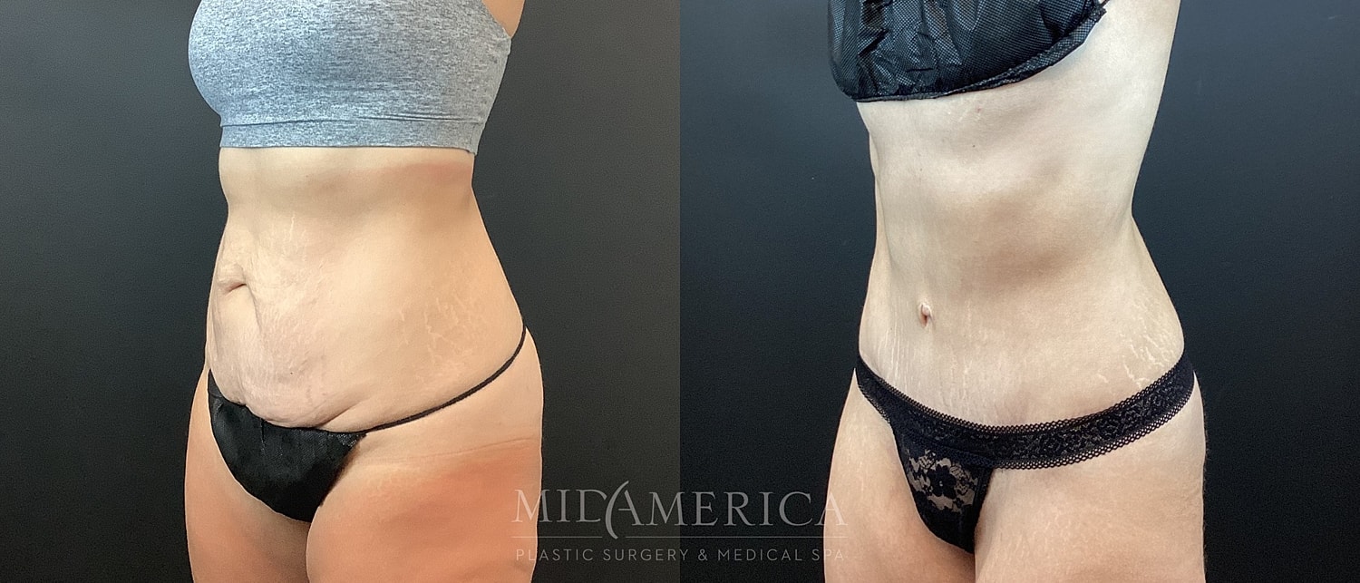 Tummy Tuck Before & After