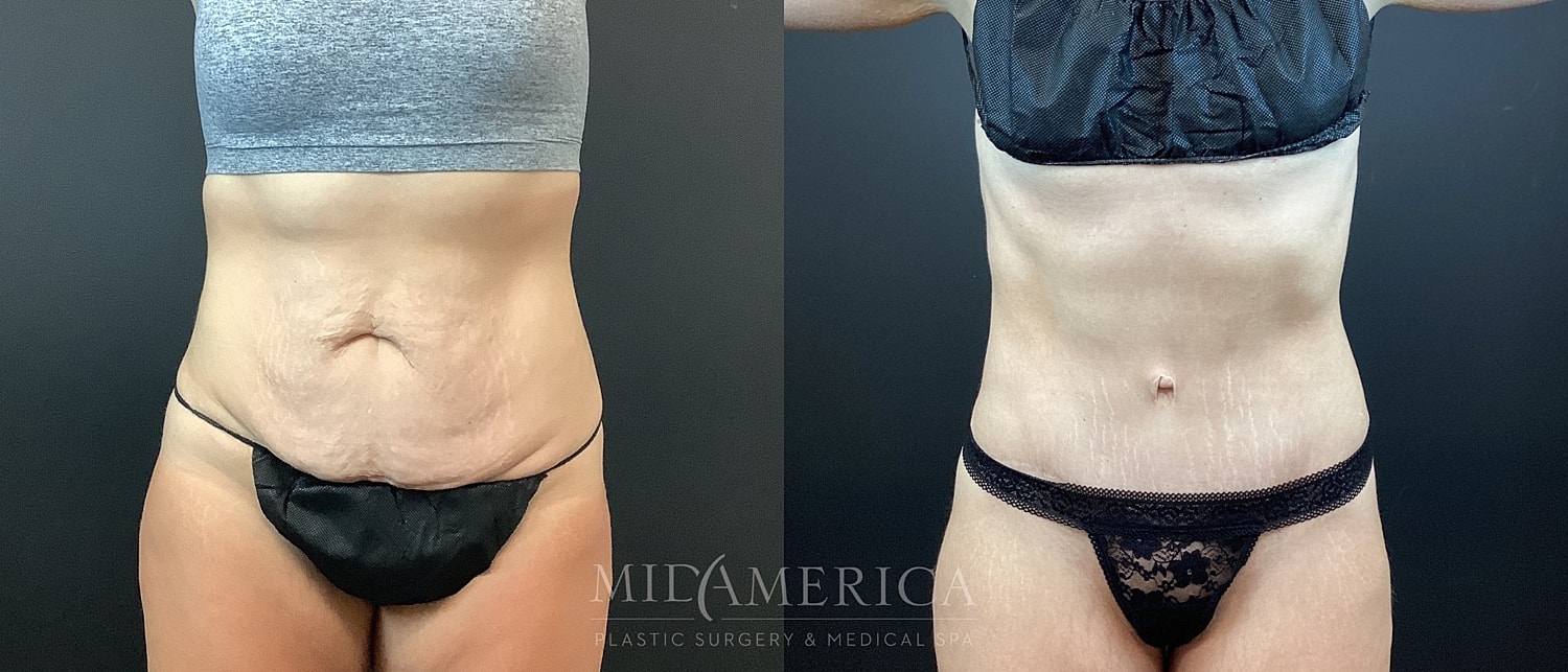 Tummy Tuck Before & After