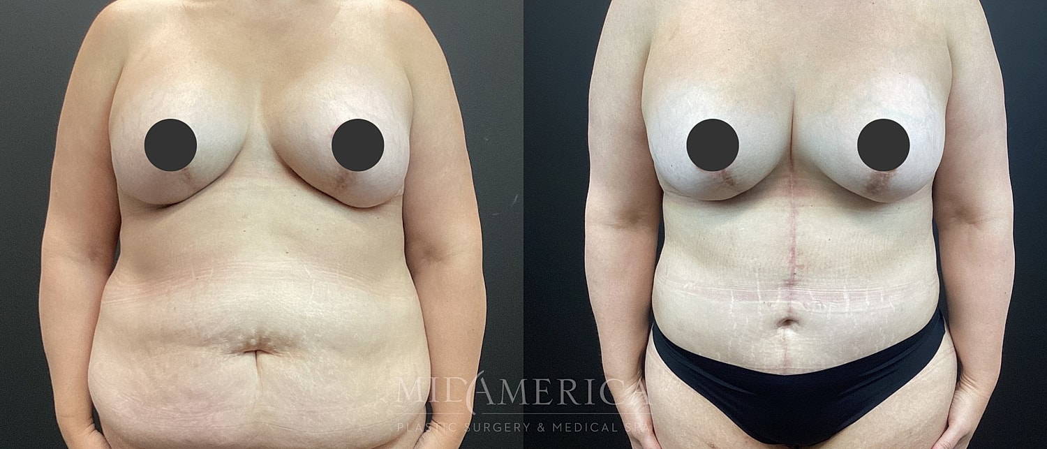 Tummy Tuck Before & After