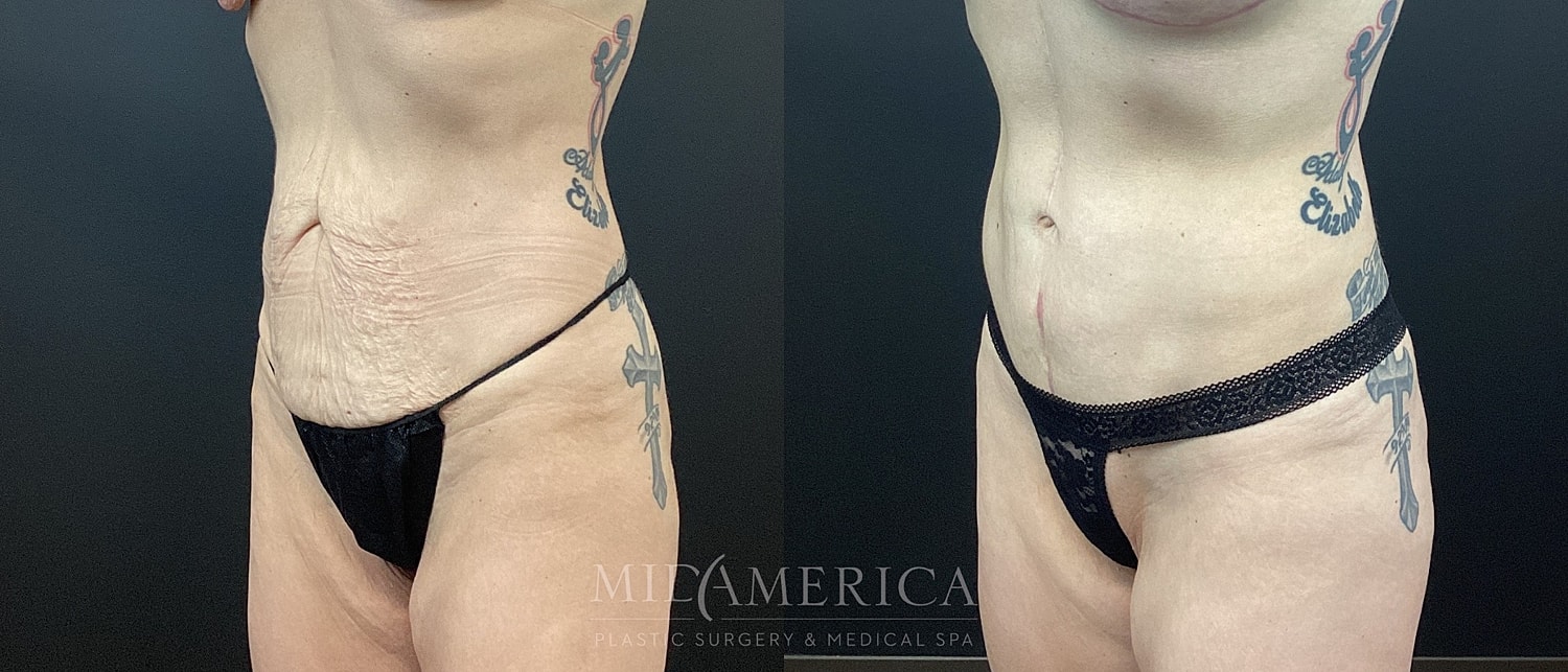 Tummy Tuck Before & After