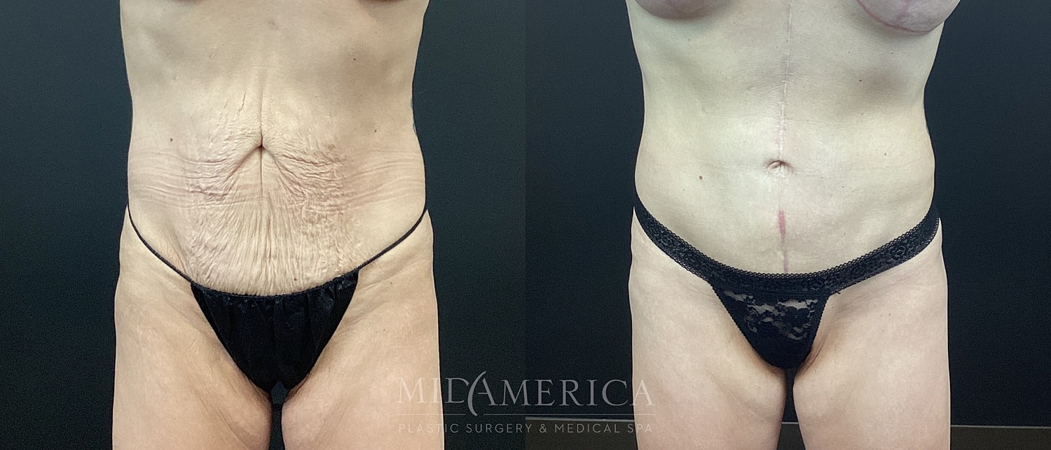 Tummy Tuck Before & After