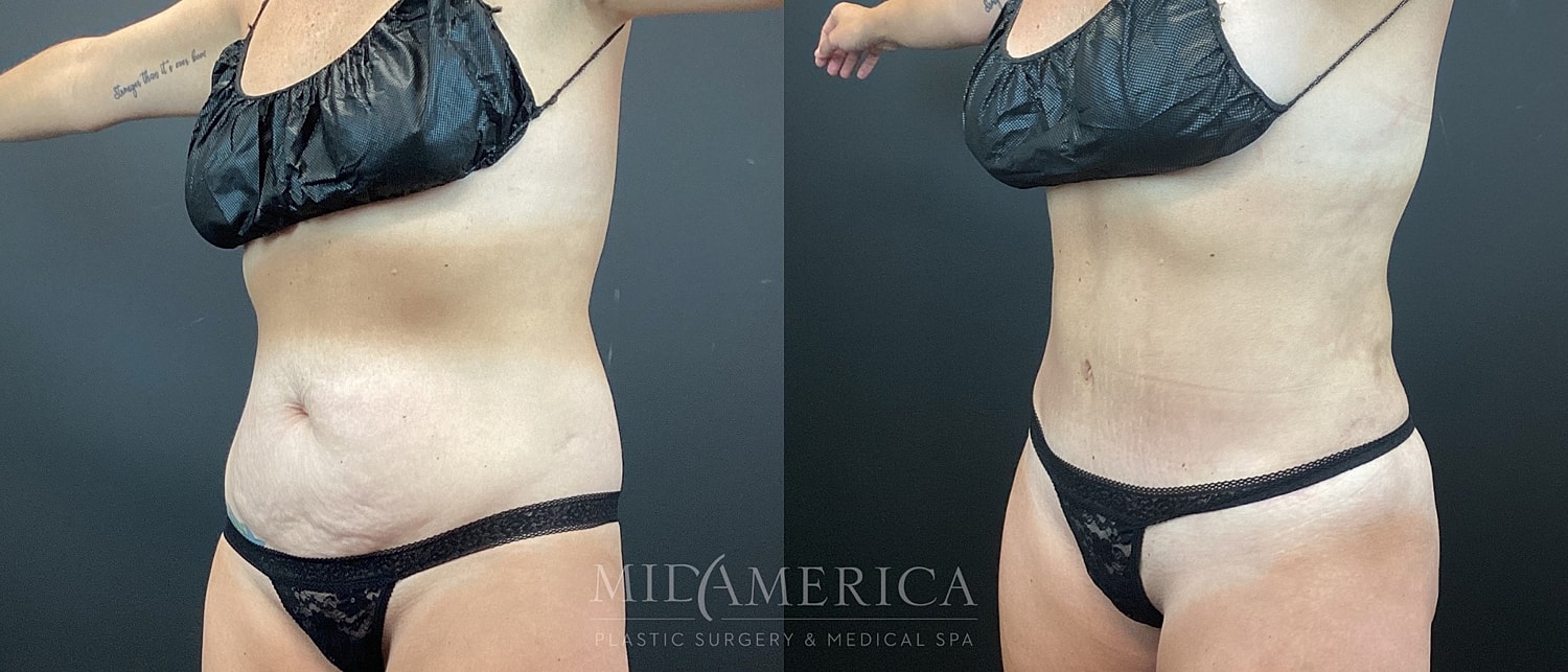 Tummy Tuck Before & After