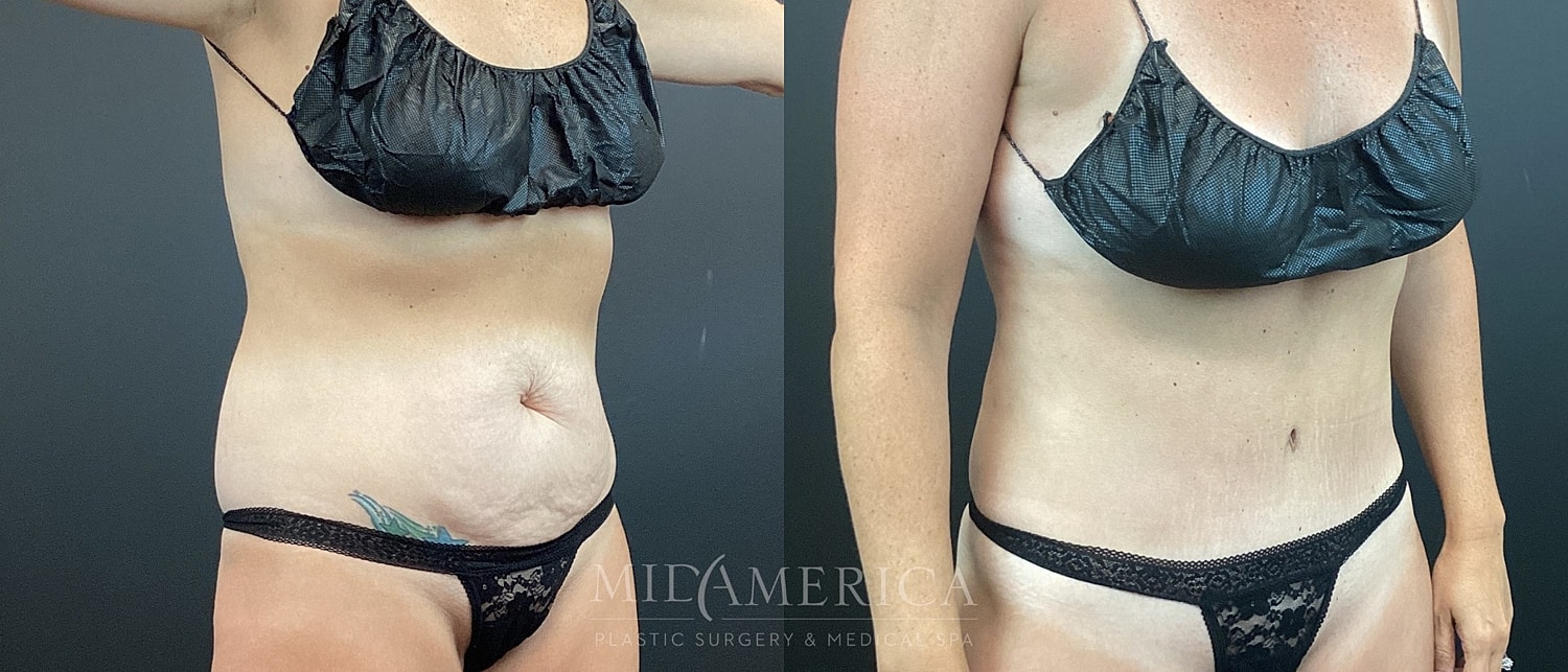 Tummy Tuck Before & After