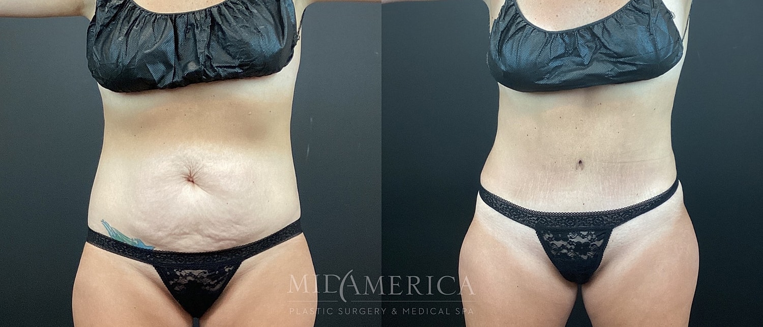 Tummy Tuck Before & After