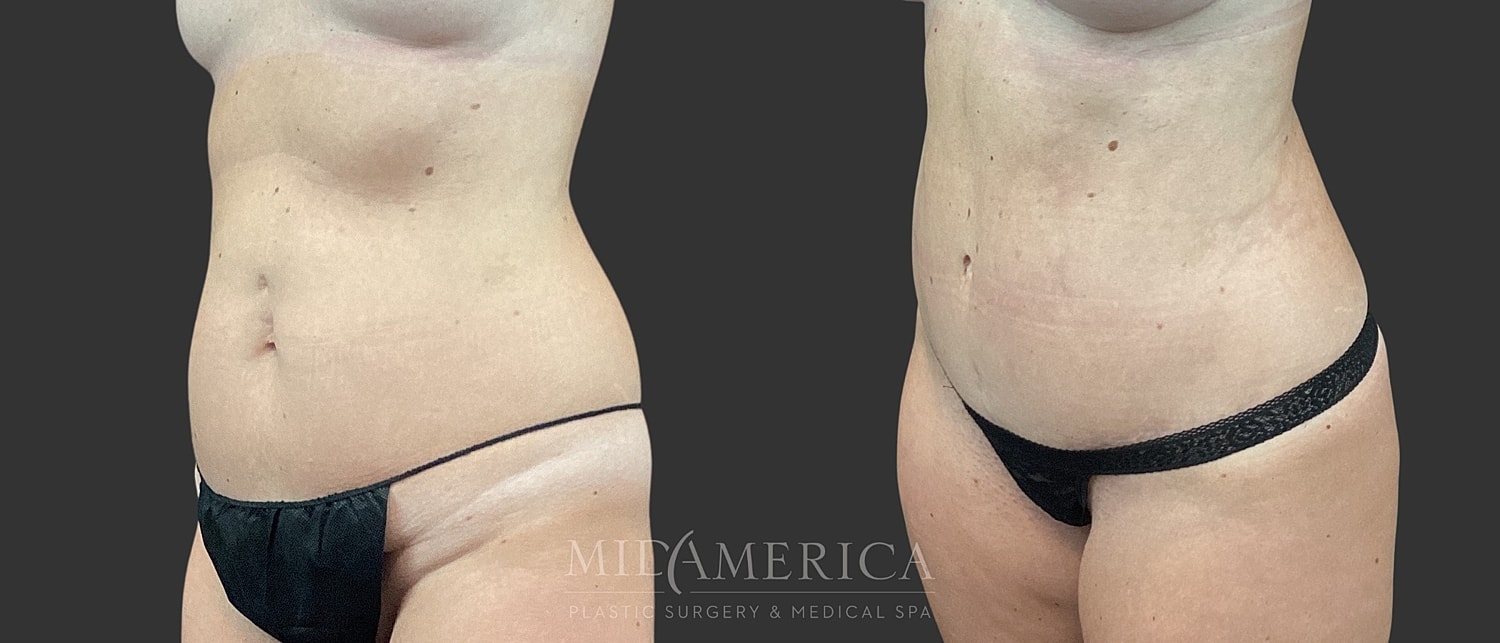 Tummy Tuck Before & After