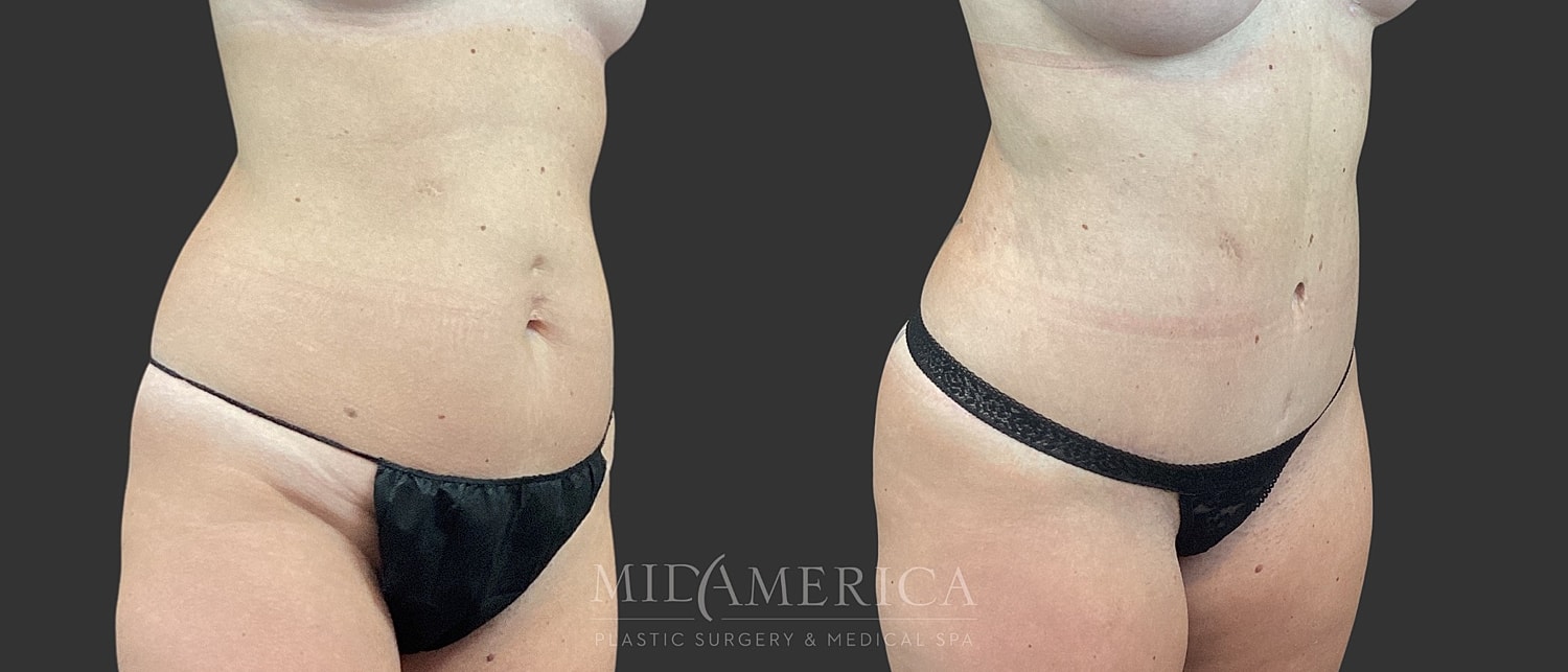 Tummy Tuck Before & After