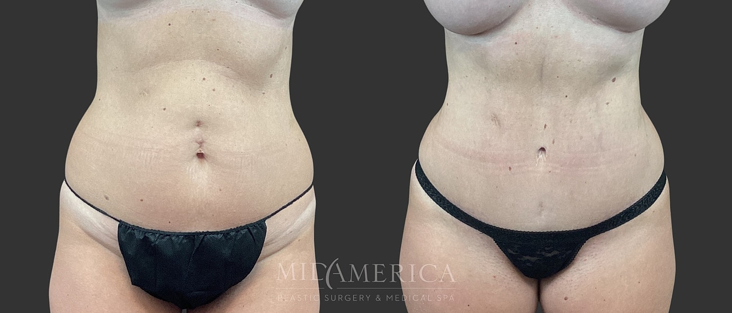 Tummy Tuck Before & After