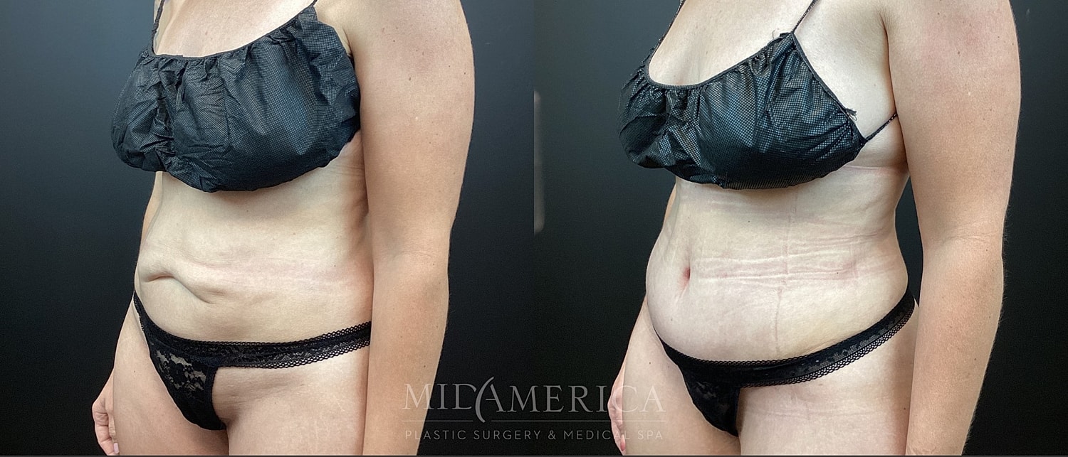 Tummy Tuck Before & After