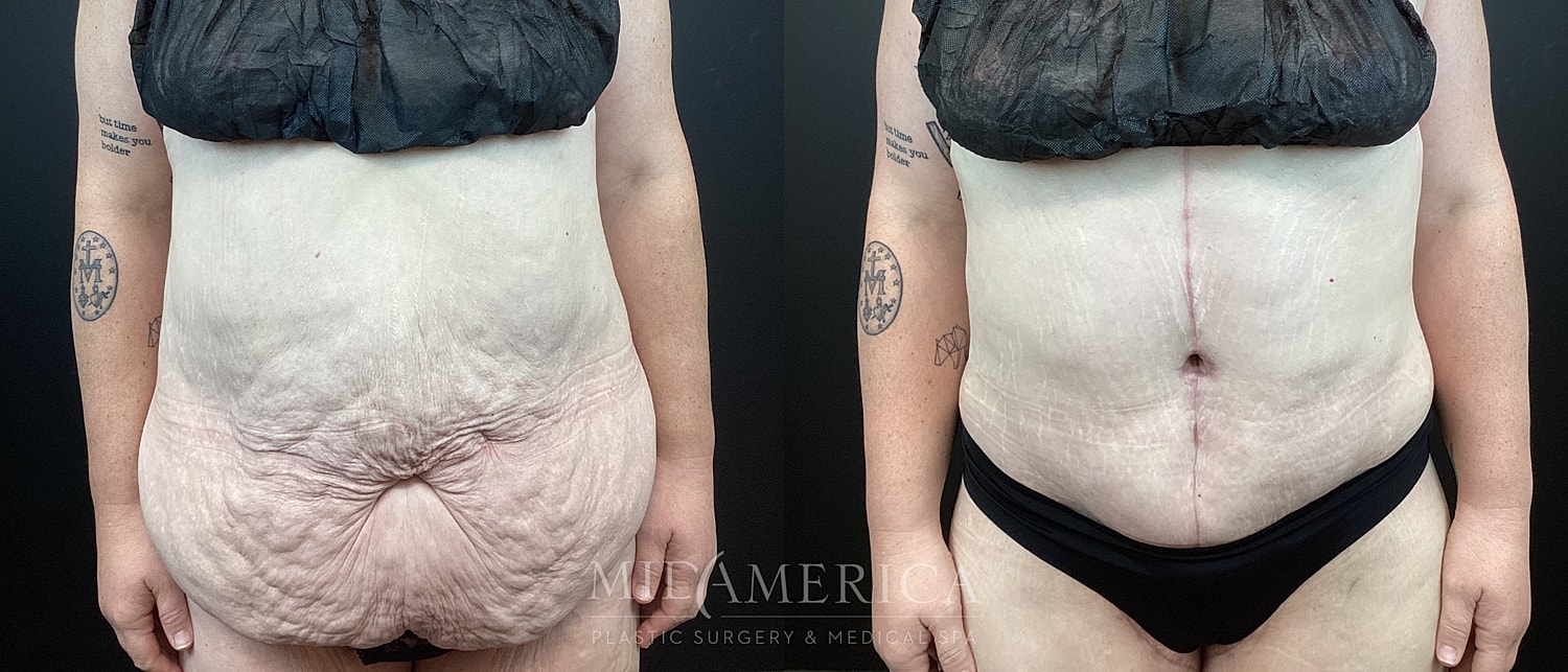 Before and after body transformation comparison.