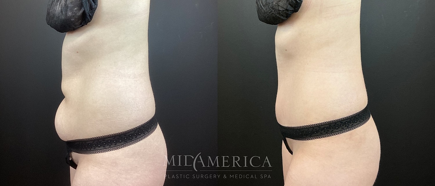 Tummy Tuck Before & After