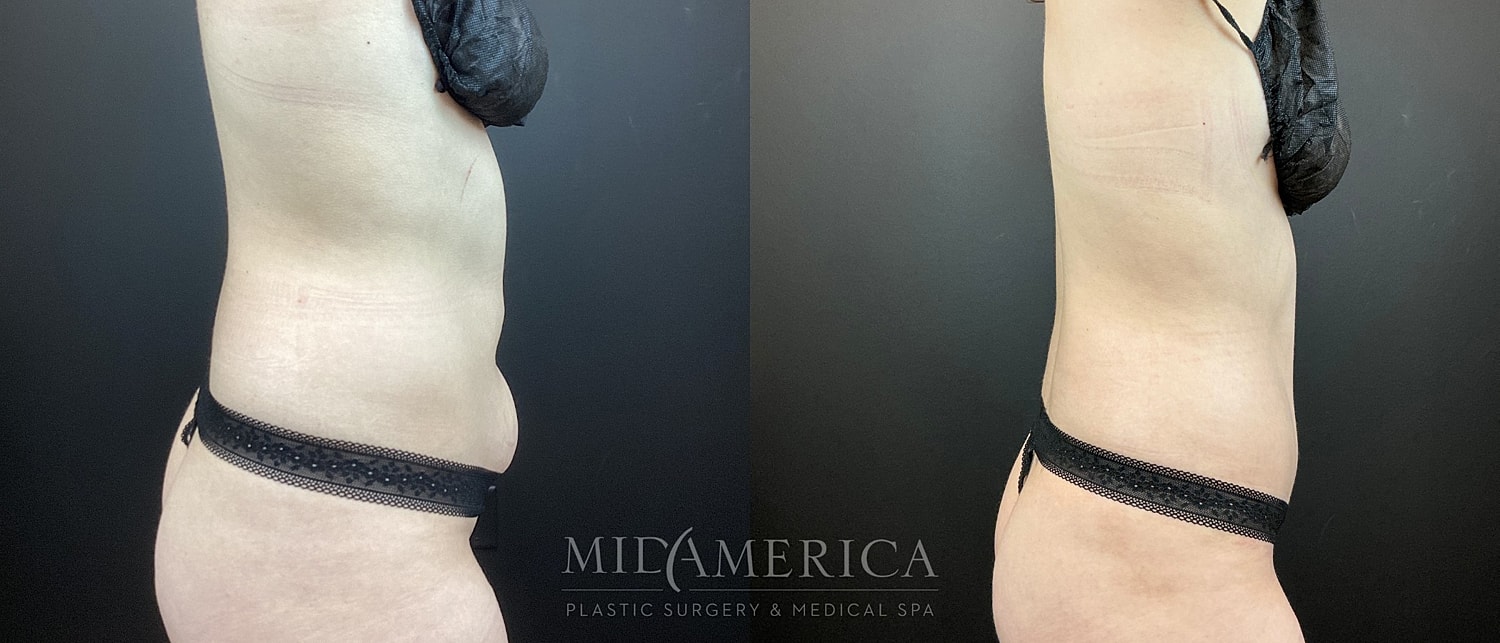 Tummy Tuck Before & After