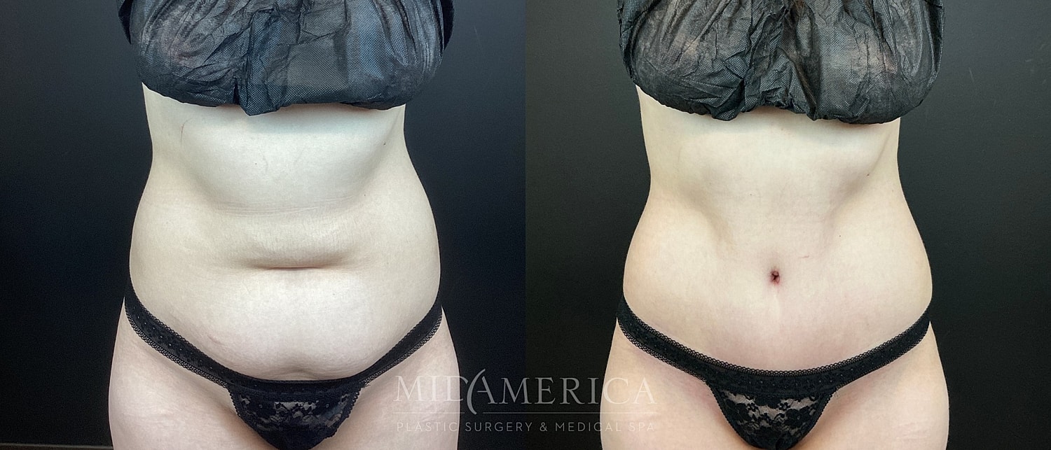 Tummy Tuck Before & After