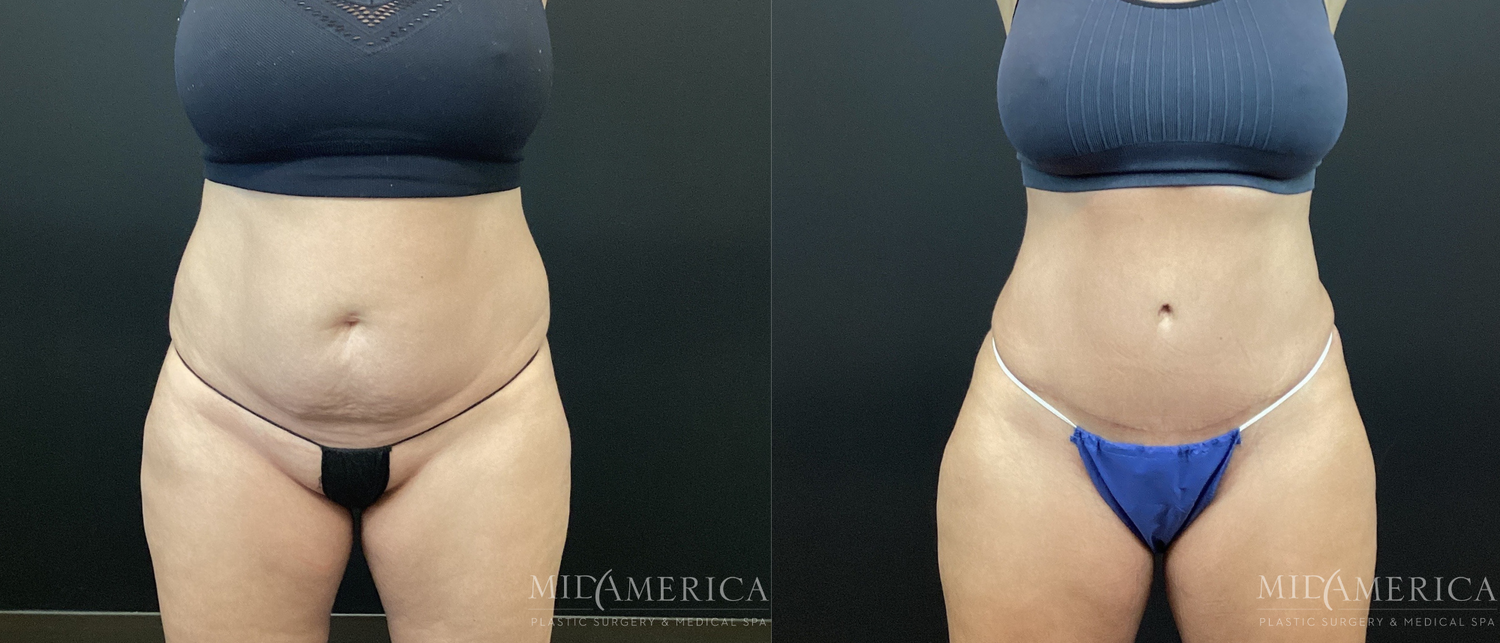 Tummy Tuck Before & After