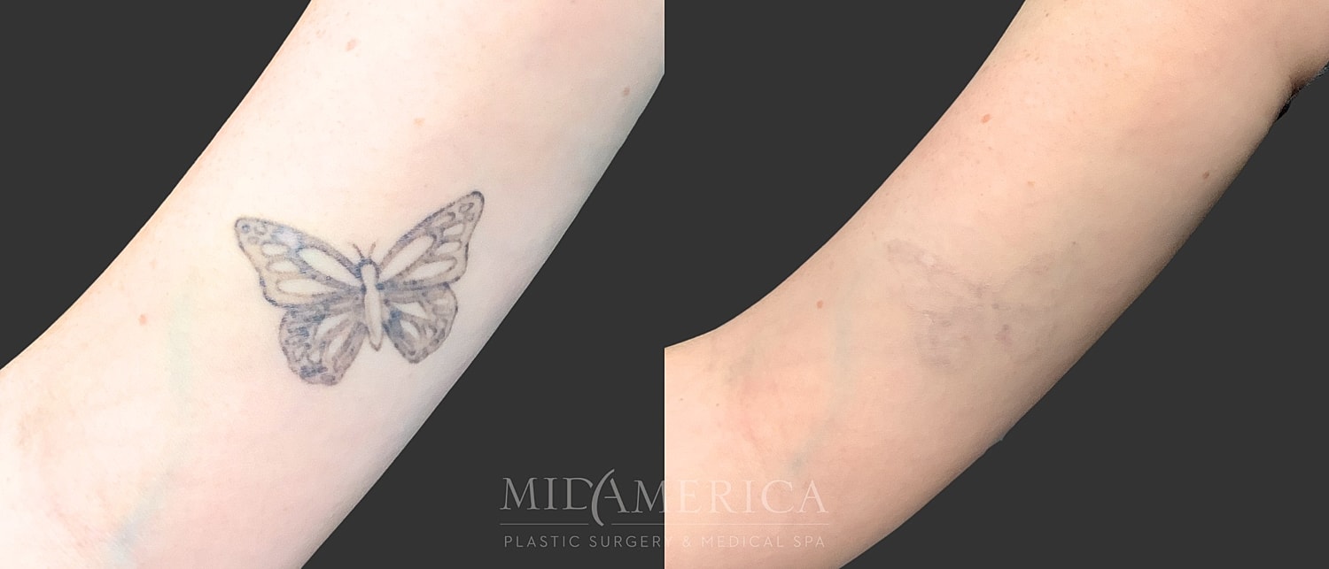 Tattoo Removal Before & After