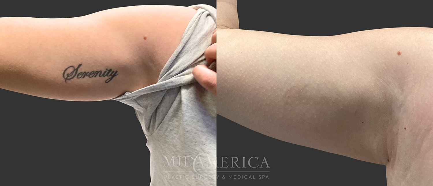 Tattoo Removal Before & After