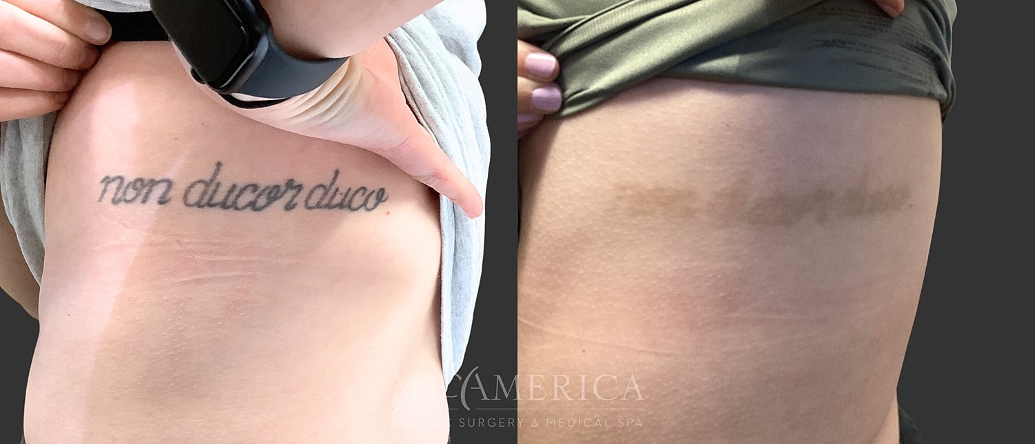 Tattoo Removal Before & After