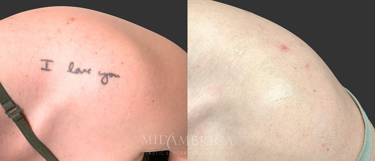 Tattoo Removal Before & After