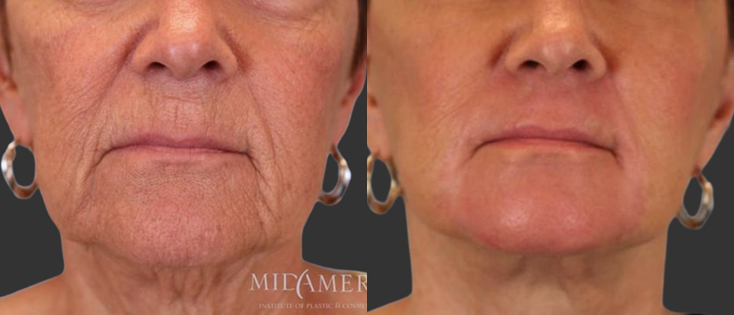 Facelift Before & After