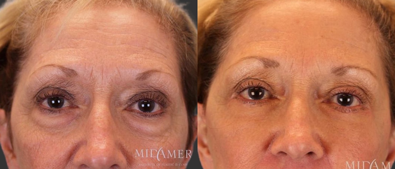 Facelift Before & After