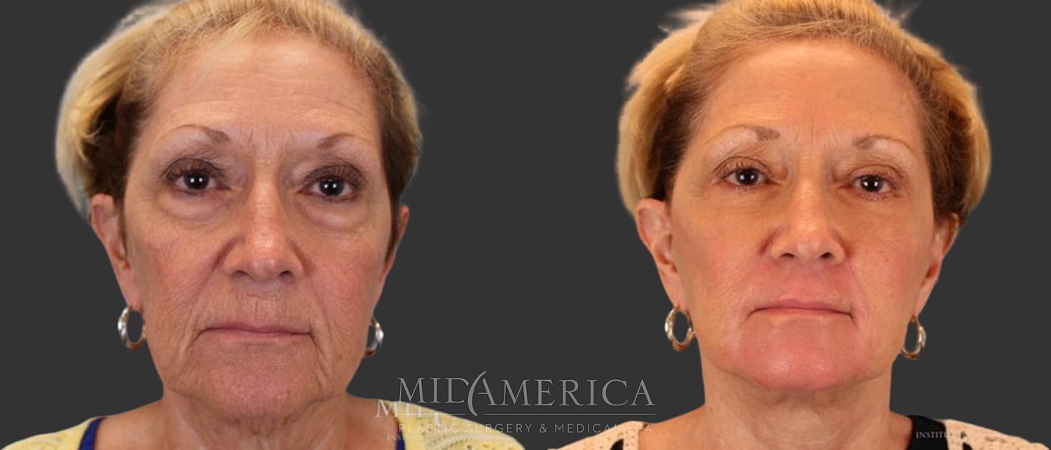 Facelift Before & After