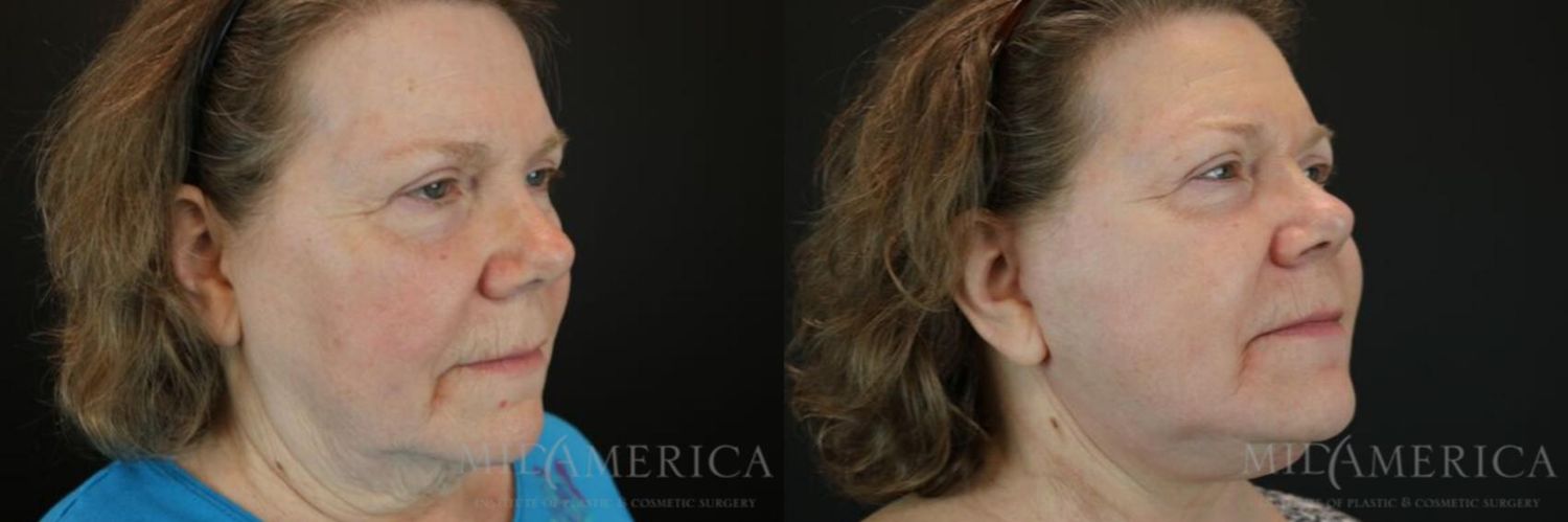 Facelift Before & After
