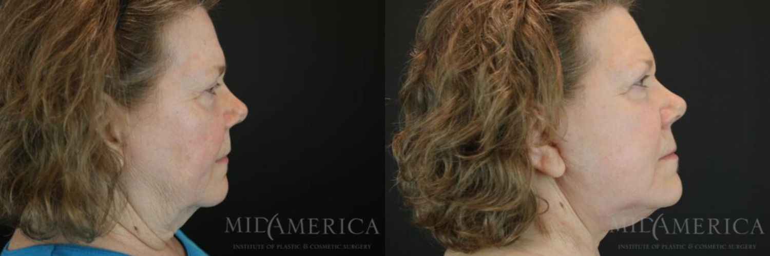 Facelift Before & After