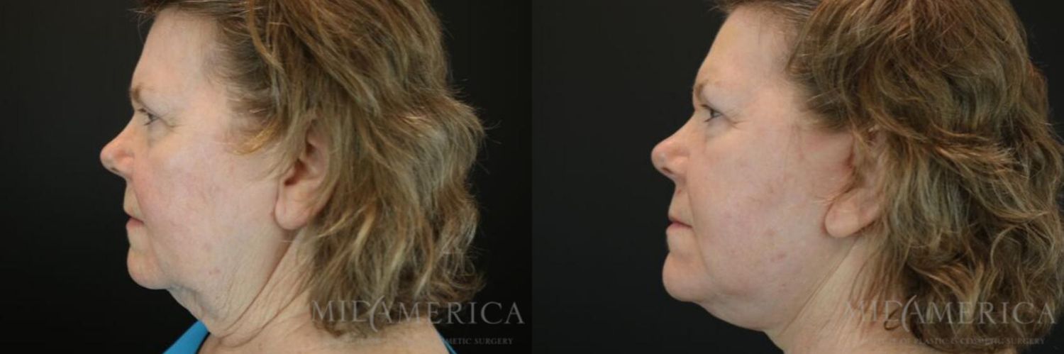 Facelift Before & After