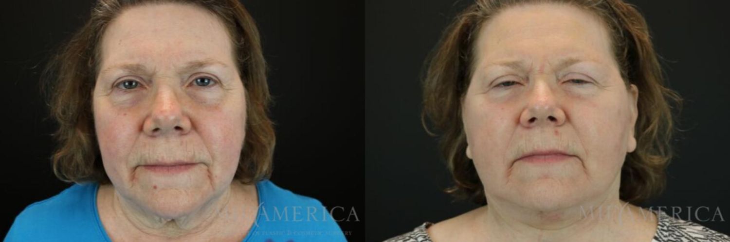 Facelift Before & After