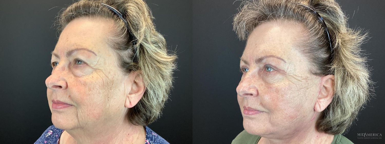 Facelift Before & After
