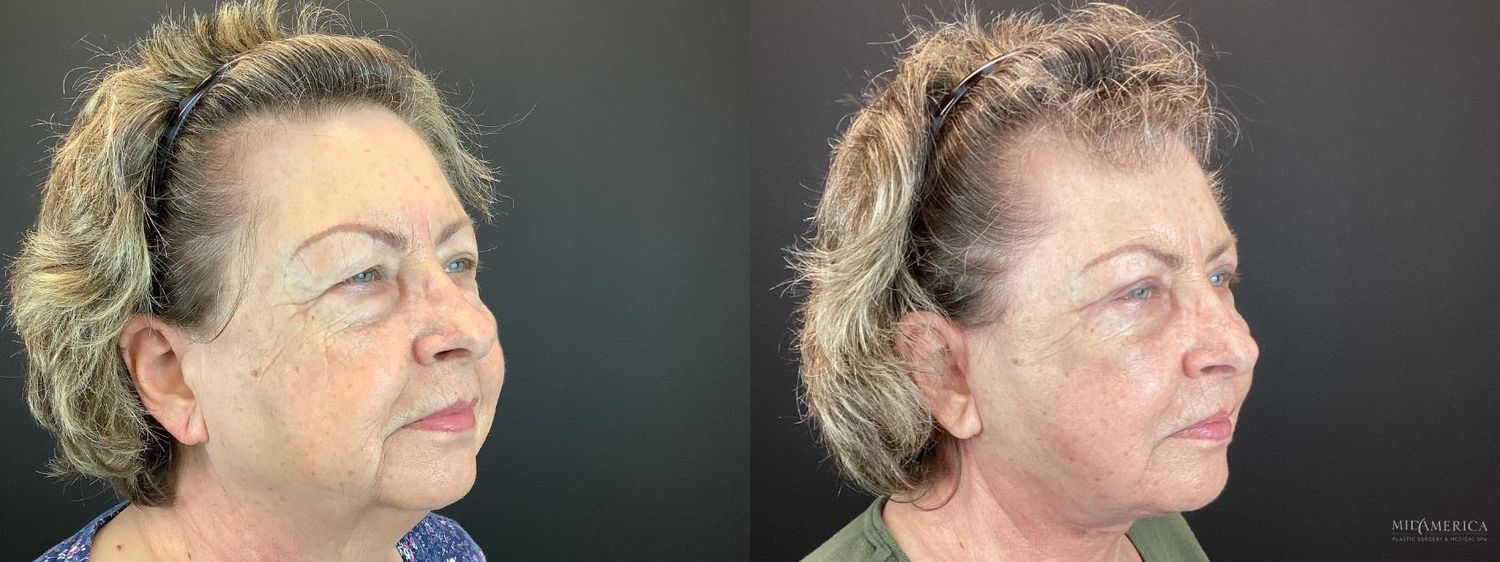 Facelift Before & After