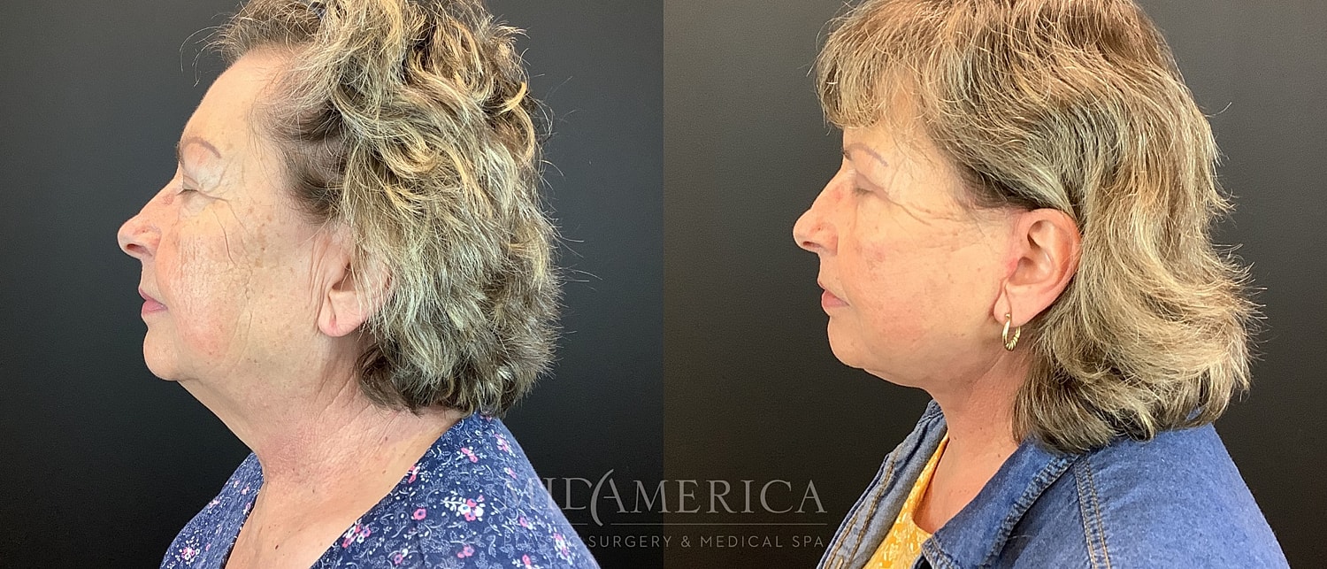 Facelift Before & After