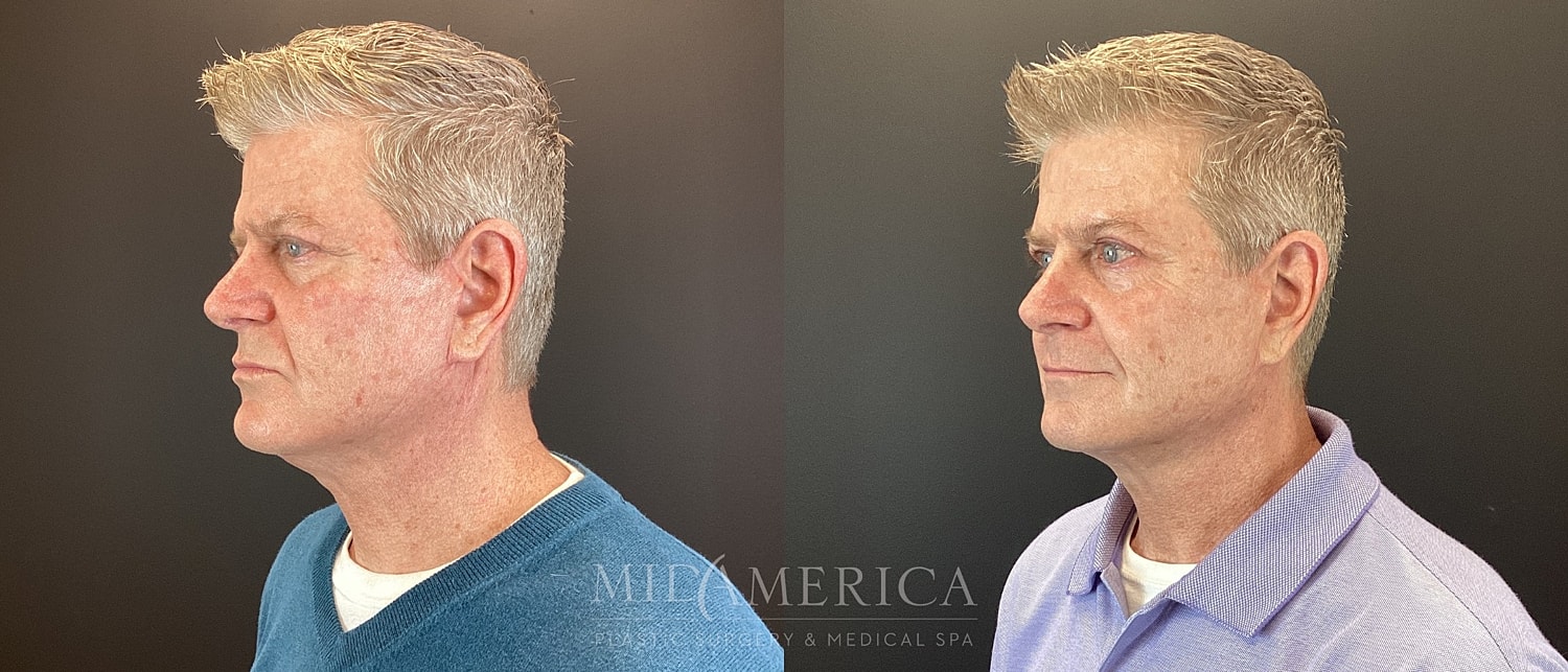 Facelift Before & After