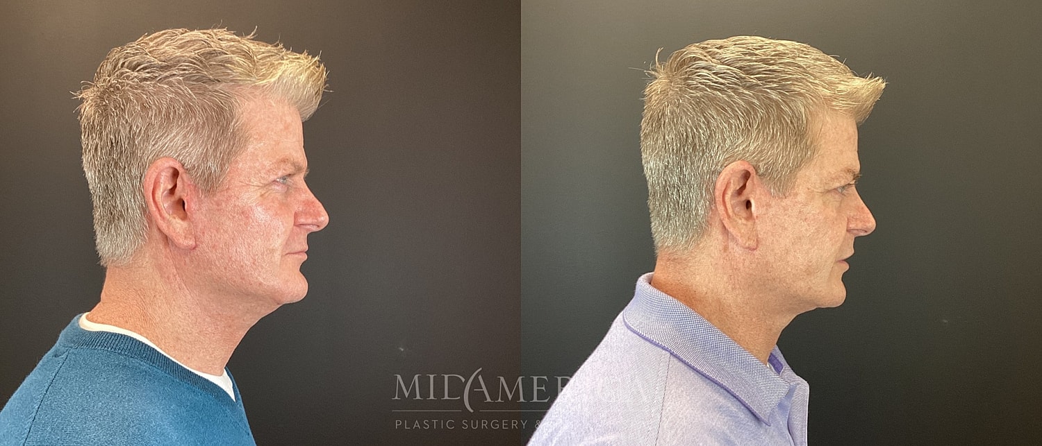 Facelift Before & After