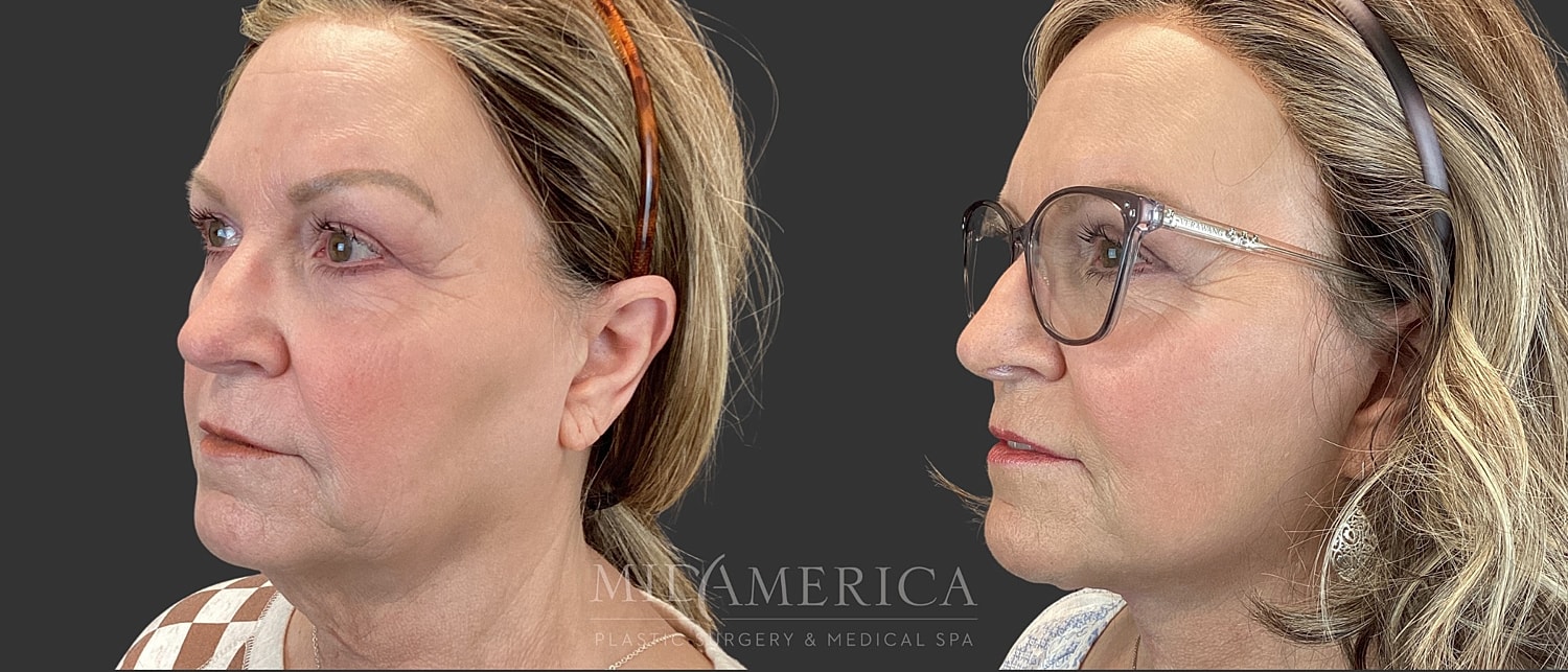 Facelift Before & After