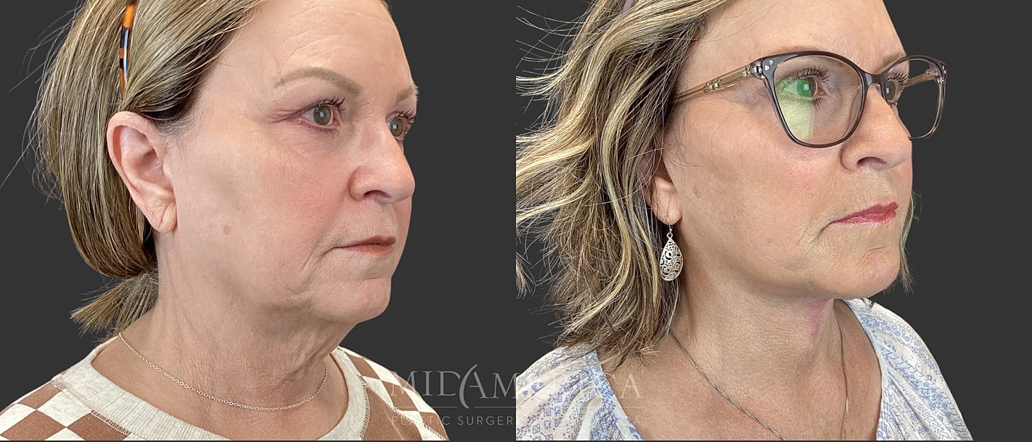 Facelift Before & After