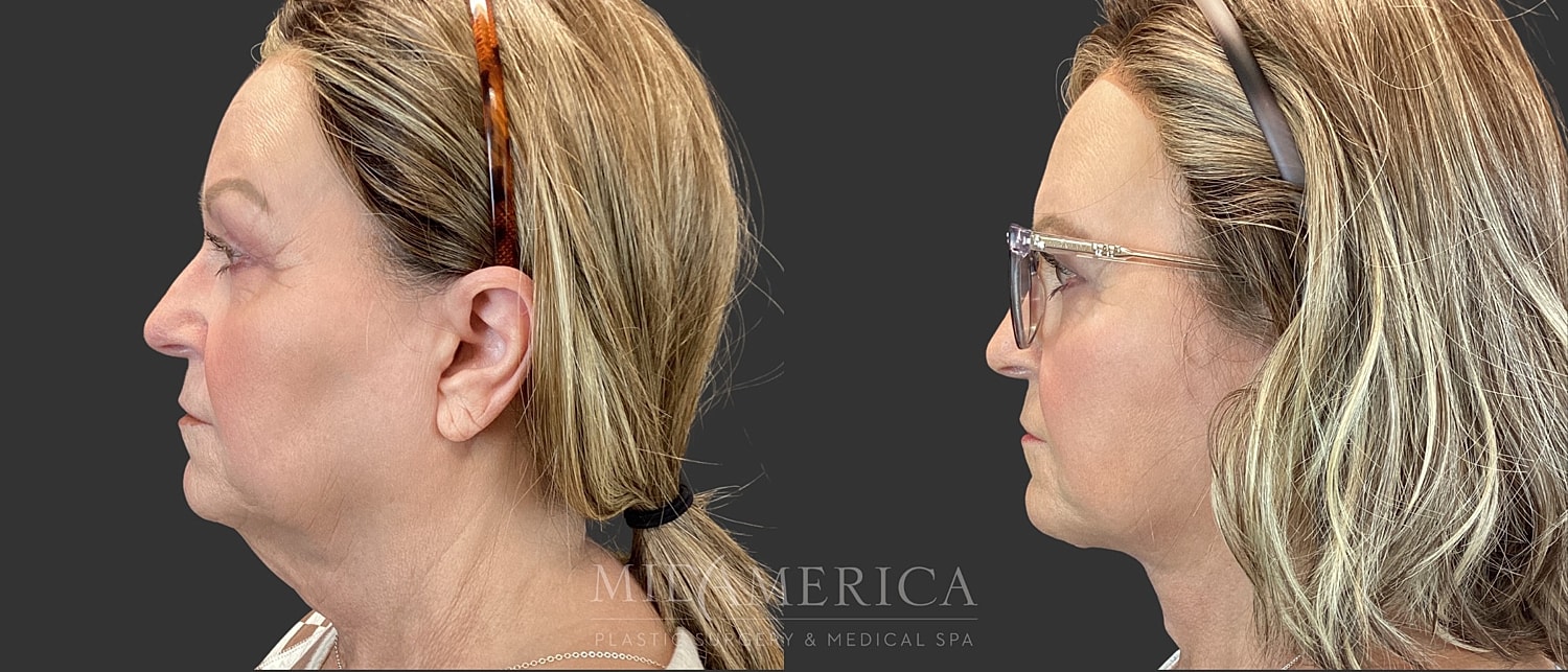 Facelift Before & After