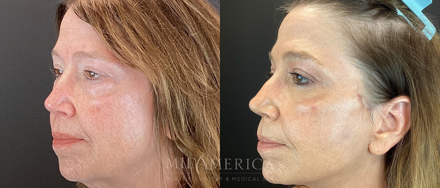 Facelift Before & After