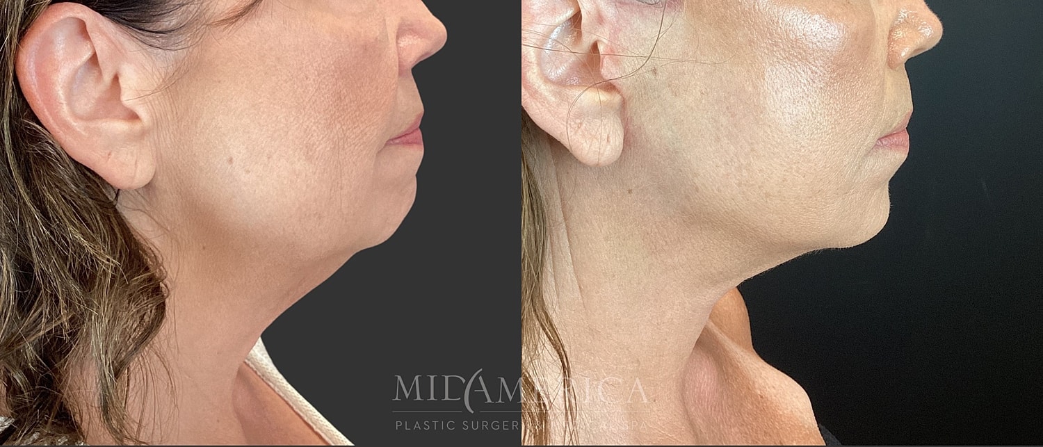 Facelift Before & After