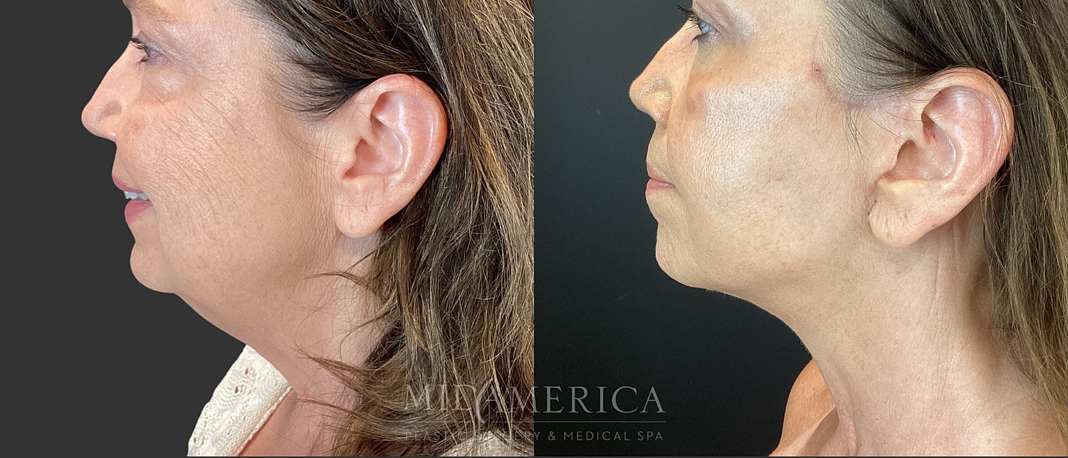 Facelift Before & After