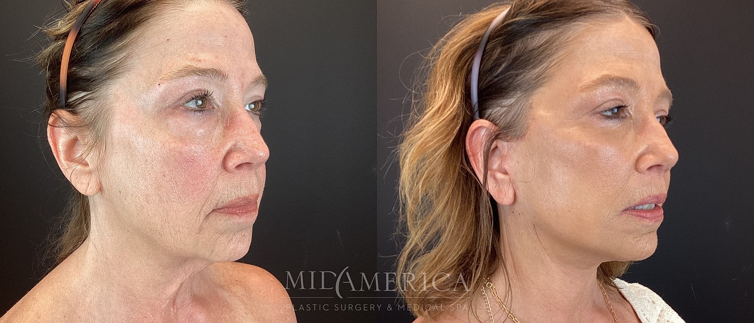 Facelift Before & After