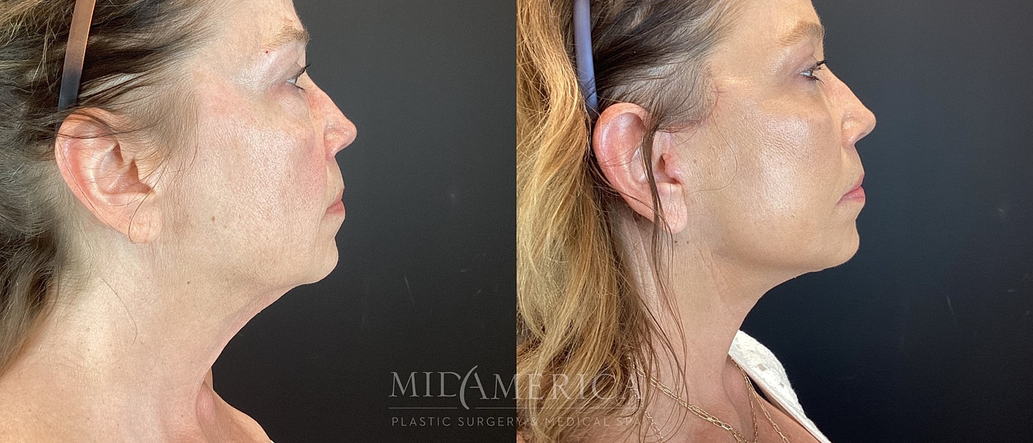Facelift Before & After