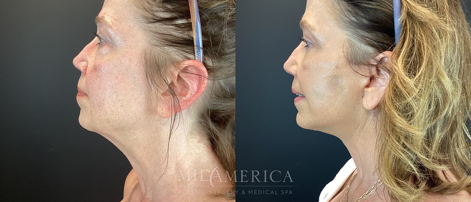 Facelift Before & After