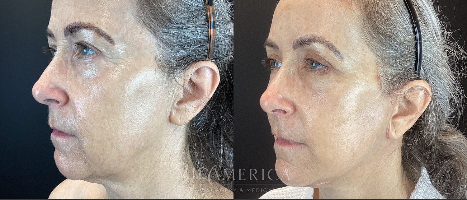 Facelift Before & After