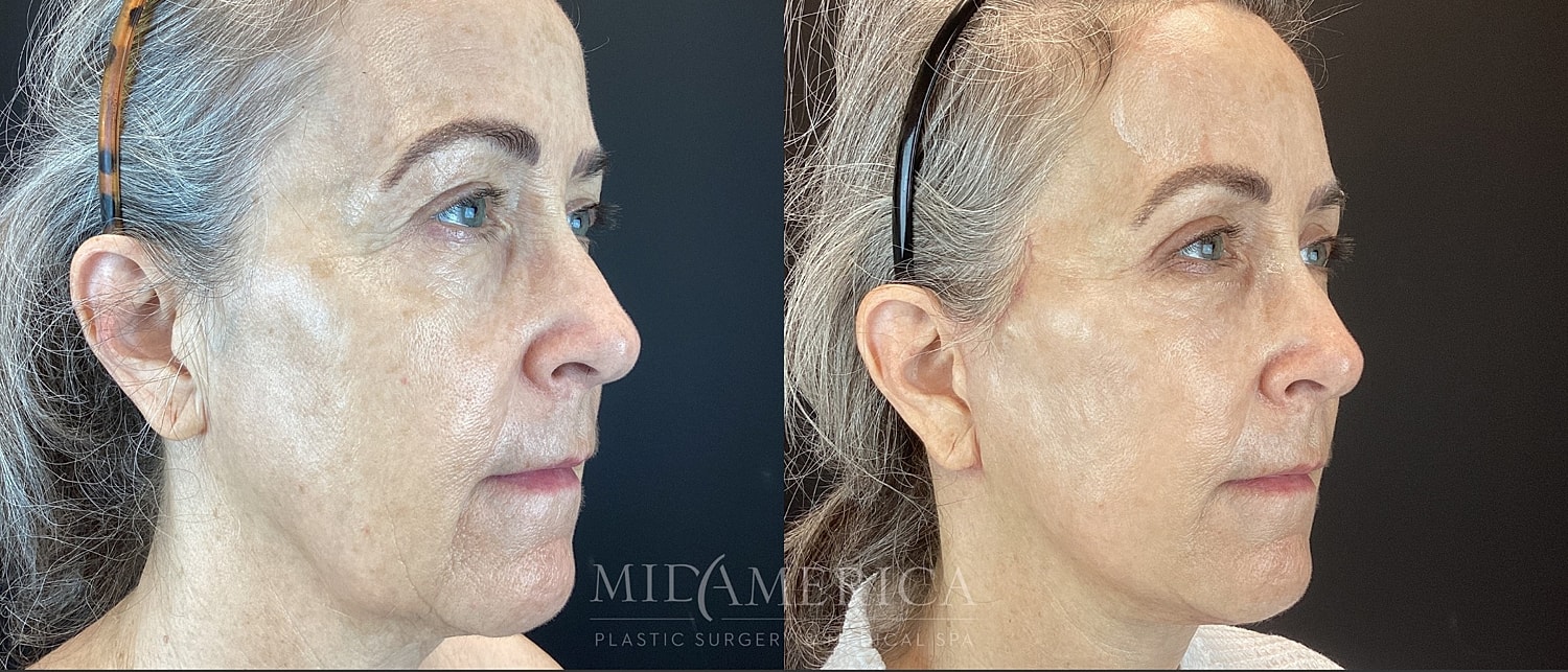 Facelift Before & After