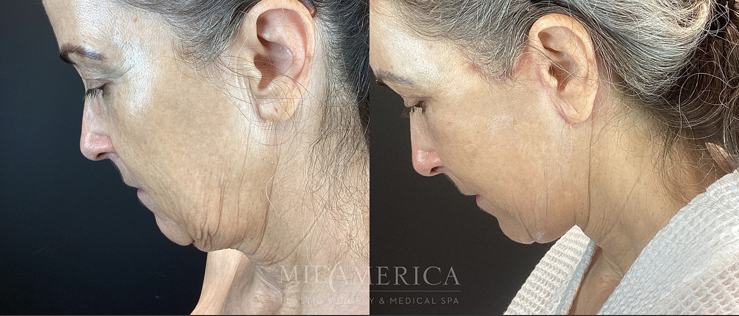 Facelift Before & After