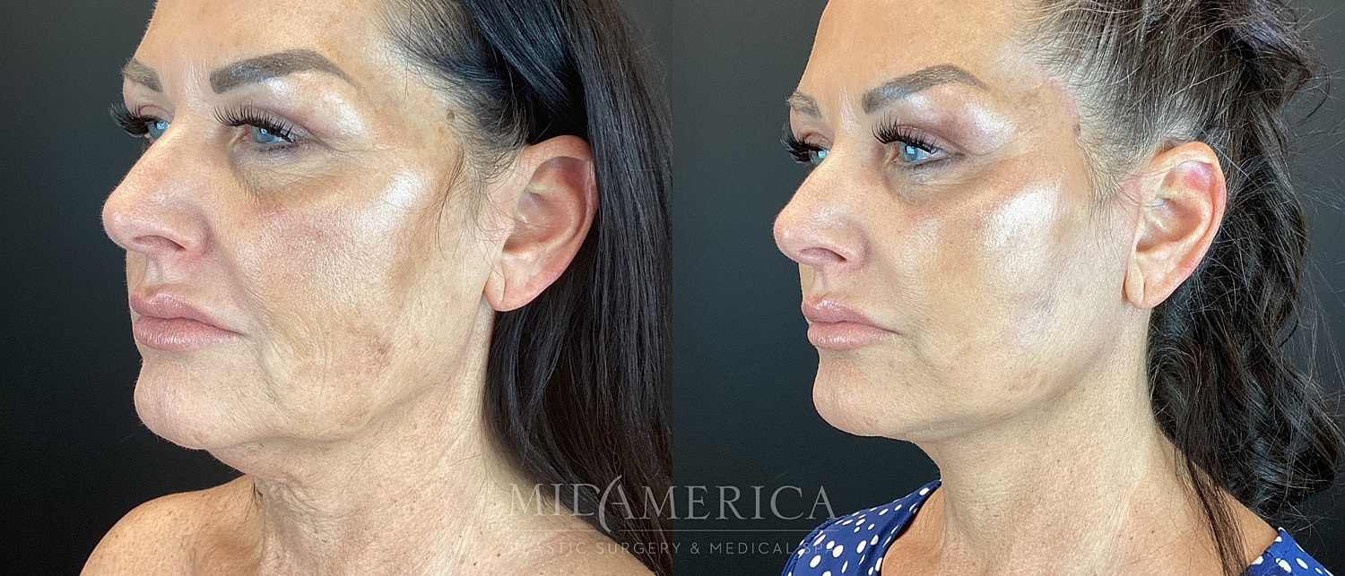 Facelift Before & After