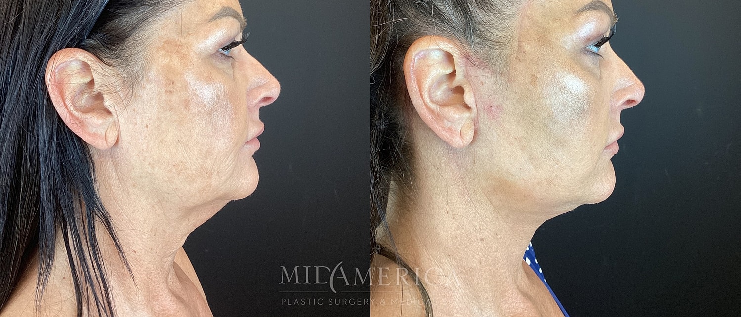Facelift Before & After
